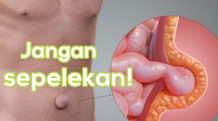 turun berok alias hernia